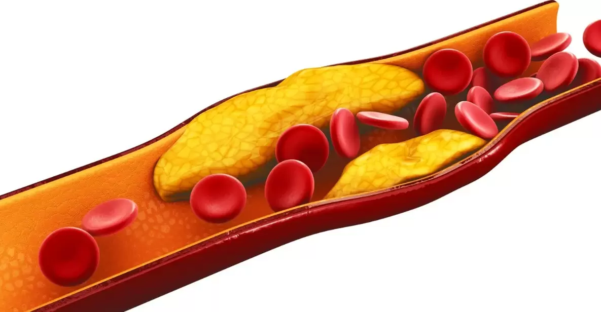 el motivo para tomar cápsulas MiCardium es la aterosclerosis vascular